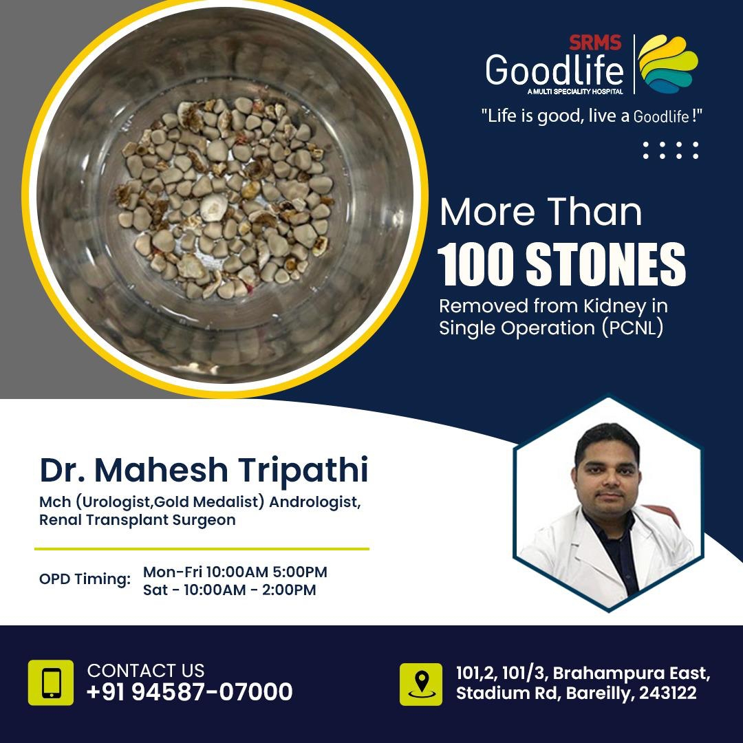 REMARKABLE ACHIEVEMENT AT SRMS GOODLIFE HOSPITAL: DOCTOR REMOVES OVER 100 KIDNEY STONES IN A SINGLE SURGERY