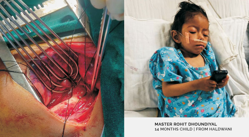Successful Management of a Case Of Large PDA with Congestive Heart Failure & Multi  Organ  Dysfunction