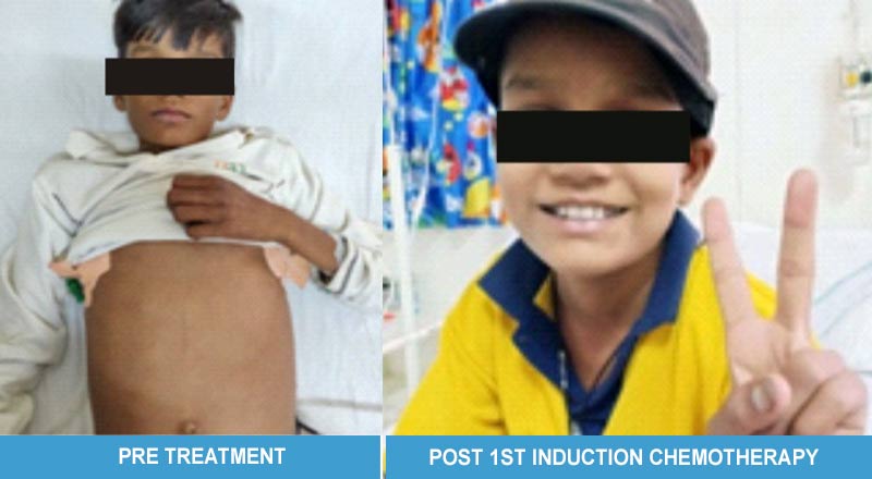 Challenging Case Of Paediatric B-NHL at SRMS IMS