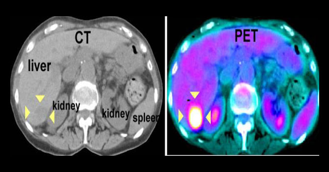 Pet-CT Scan - SRMS IMS Bareilly