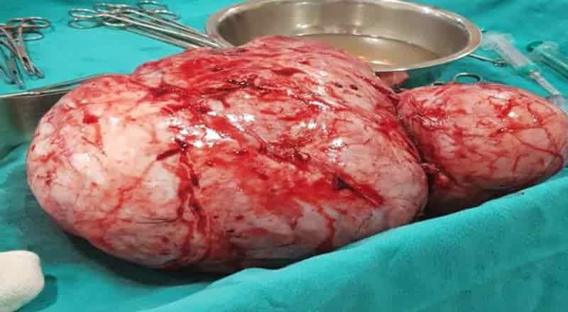 6 Kg Tumor Operated at SRMSIMS In Critical Condition