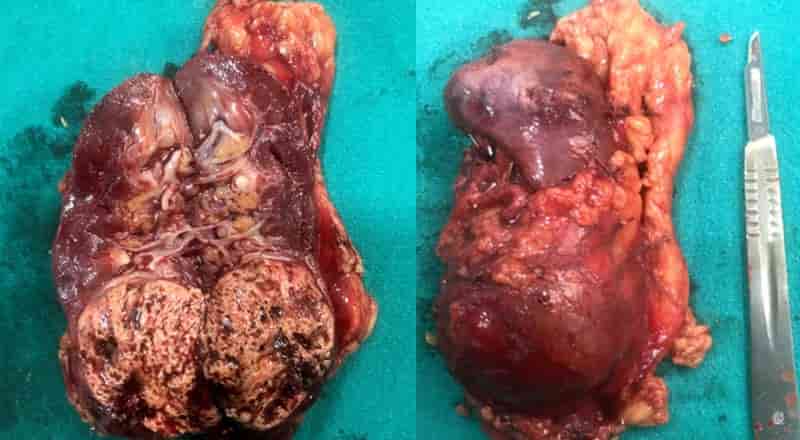 Kidney Cancer-operated Laparoscopically at SRMS IMS