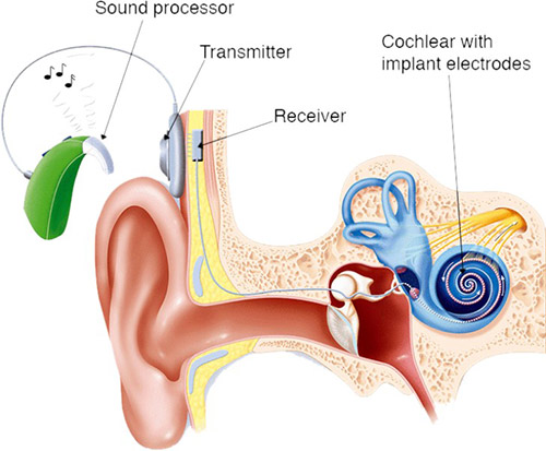 Cochlear-Image