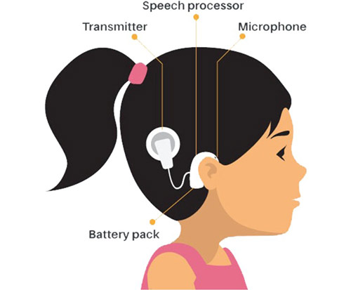 Cochlear-Image2