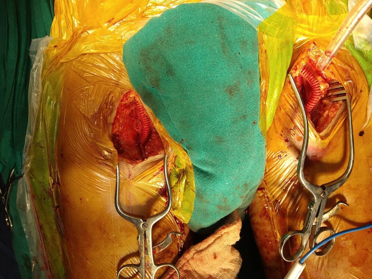 Aorto-bifemoral-bypass-surgery