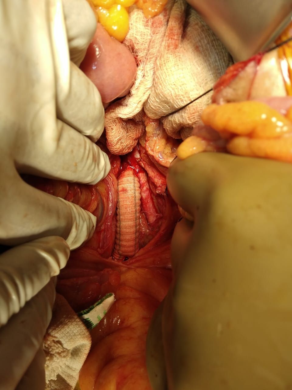 Aorto-bifemoral-bypass