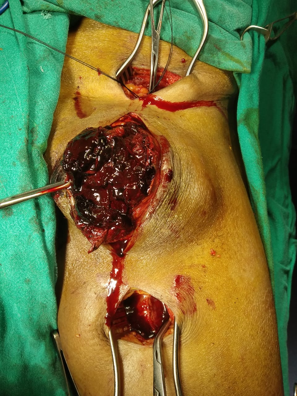 Femoral-artery-pseudo-aneurysm-repair