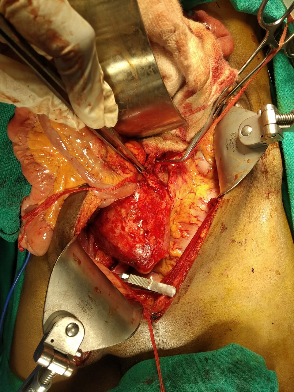 Iliac-Artery-aneurysm