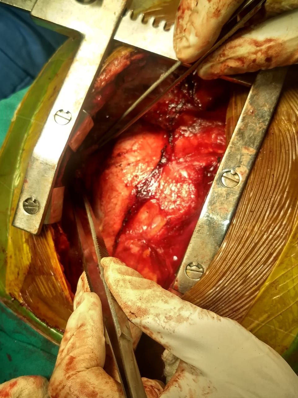 Pericardectomy