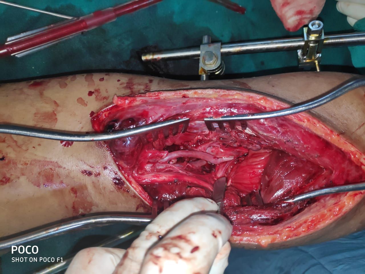 Popliteal-artery-repair